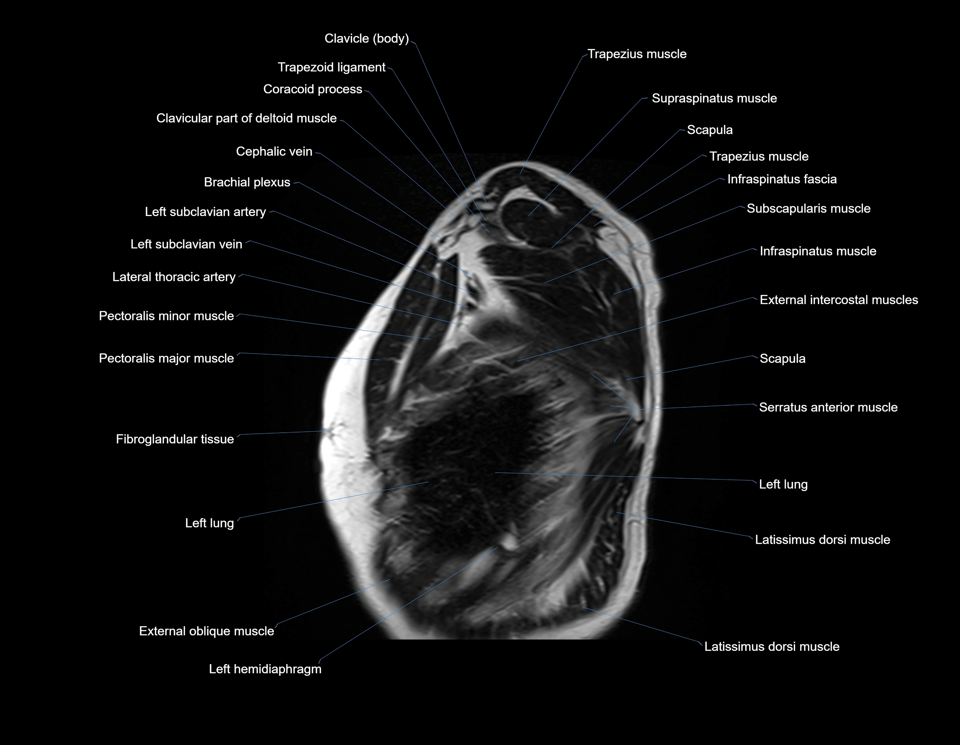 MRI chest (thorax) sagittal labelled cross sectional anatomy 3T radiology image-img-00001-00033.webp